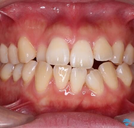 重度の叢生をインビザラインで改善 治療前