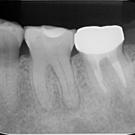 奥歯の痛み、顕微鏡を使用した精密根管治療で解消 治療前