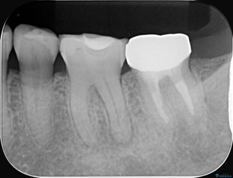 奥歯の痛み、顕微鏡を使用した精密根管治療で解消 ビフォー