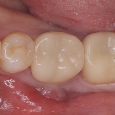 【歯牙移植】抜歯と言われた奥歯に親知らずを移植 治療前