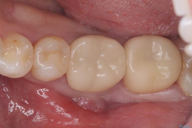【歯牙移植】抜歯と言われた奥歯に親知らずを移植 治療前画像