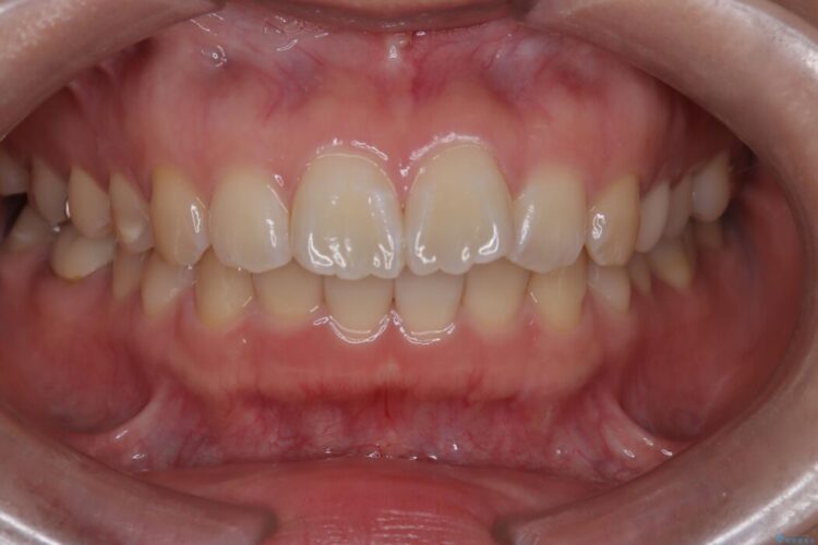 目立たないハーフリンガル矯正で口元の突出感を改善 治療前画像