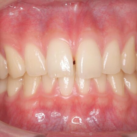 ワイヤー矯正ですきっ歯の改善 治療前