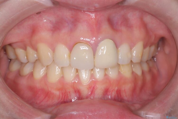 他院で治療した前歯の見た目と根の問題を解決 ビフォー