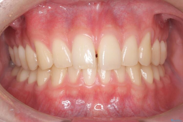 ワイヤー矯正ですきっ歯の改善 ビフォー