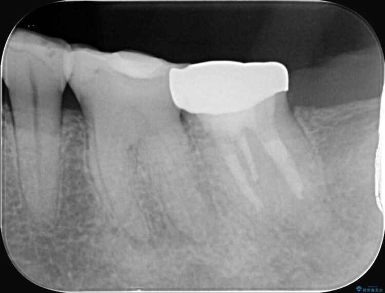 奥歯の痛み、顕微鏡を使用した精密根管治療で解消 治療前画像