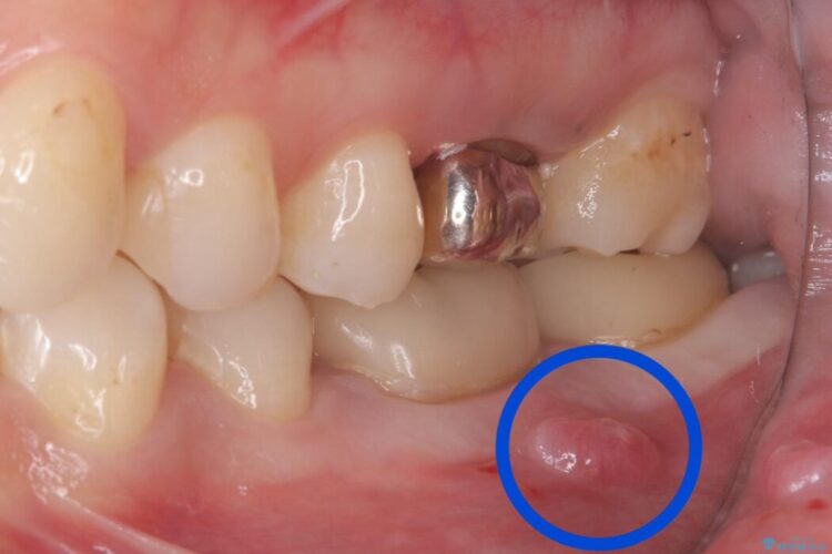 【歯牙移植】抜歯と言われた奥歯に親知らずを移植 治療前画像
