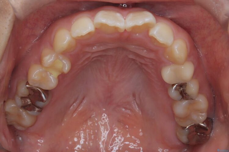 目立たないハーフリンガル矯正で口元の突出感を改善 治療前画像