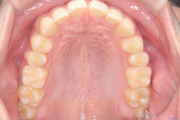 ワイヤー矯正ですきっ歯の改善 治療前画像