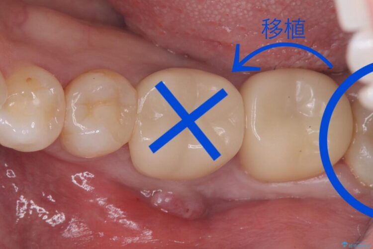【歯牙移植】抜歯と言われた奥歯に親知らずを移植 治療前画像