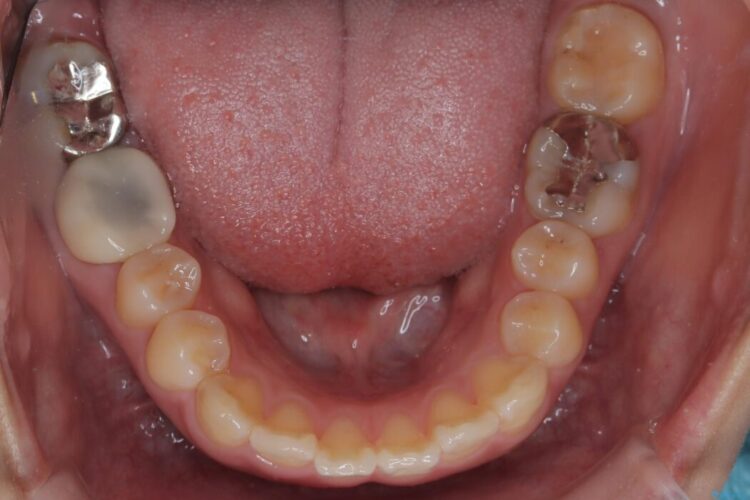 目立たないハーフリンガル矯正で口元の突出感を改善 治療前画像