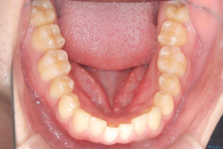 ワイヤー矯正ですきっ歯の改善 治療前画像