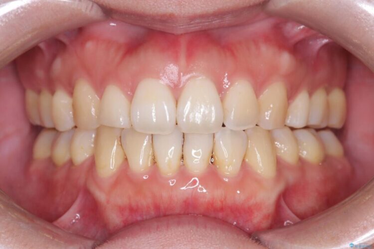 重度の叢生をインビザラインで改善 治療後画像