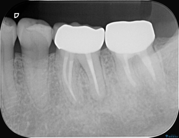 奥歯の痛み、顕微鏡を使用した精密根管治療で解消 アフター