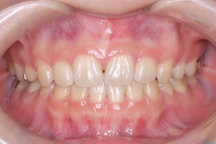 目立たないハーフリンガル矯正で口元の突出感を改善 治療後画像