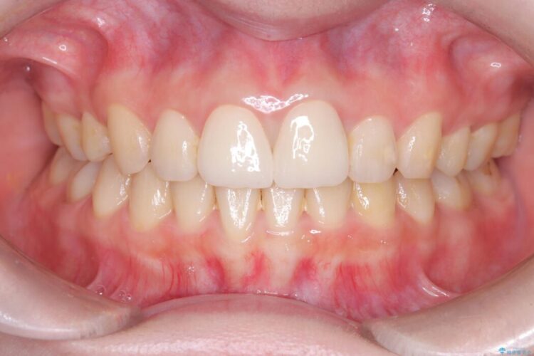 他院で治療した前歯の見た目と根の問題を解決 アフター