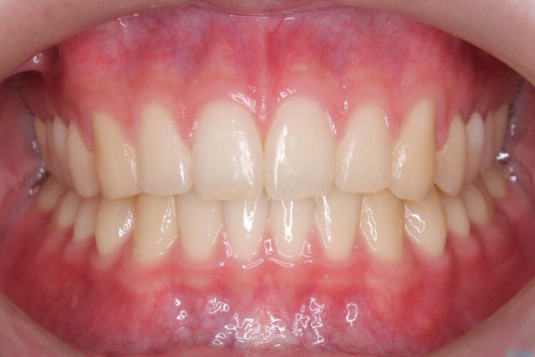 ワイヤー矯正ですきっ歯の改善 アフター