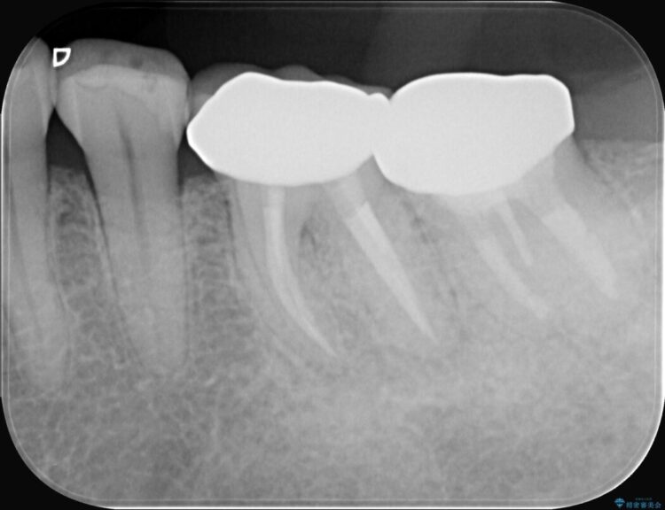 奥歯の痛み、顕微鏡を使用した精密根管治療で解消 治療後画像