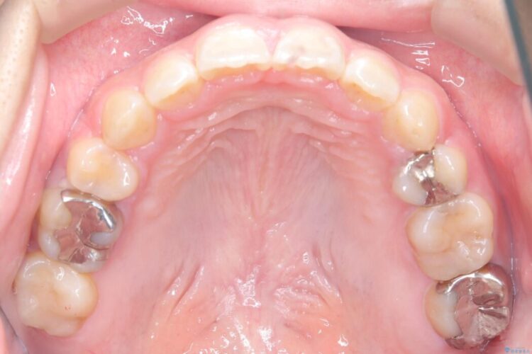 目立たないハーフリンガル矯正で口元の突出感を改善 治療後画像