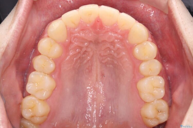 ワイヤー矯正ですきっ歯の改善 治療後画像
