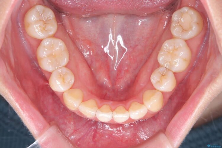 重度の叢生をインビザラインで改善 治療後画像