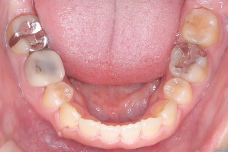 目立たないハーフリンガル矯正で口元の突出感を改善 治療後画像