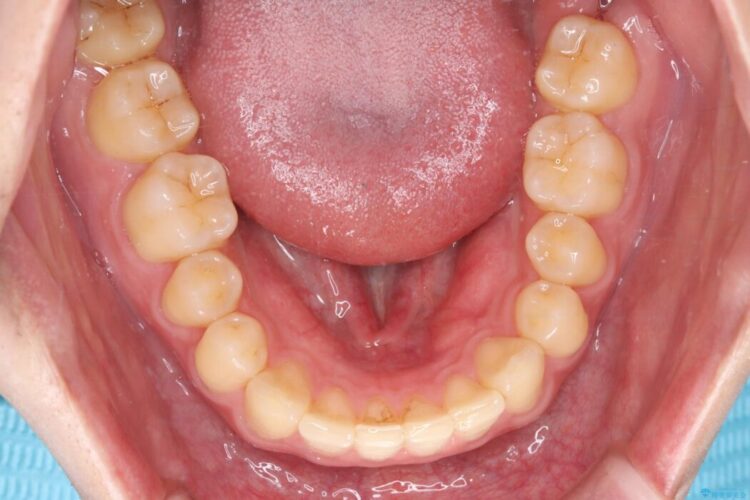 ワイヤー矯正ですきっ歯の改善 治療後画像