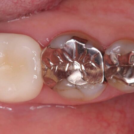 銀歯の下の虫歯をオールセラミッククラウンで修復 治療前