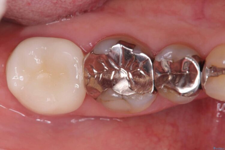 銀歯の下の虫歯をオールセラミッククラウンで修復 ビフォー