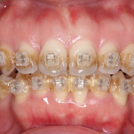 矯正治療中のエアフロークリーニング 治療前