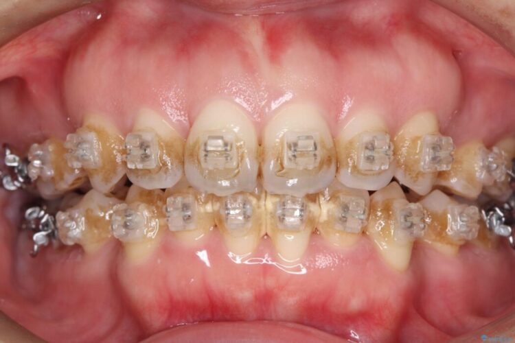 矯正治療中のエアフロークリーニング 治療前画像