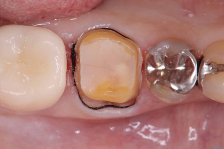 銀歯の下の虫歯をオールセラミッククラウンで修復 治療途中画像