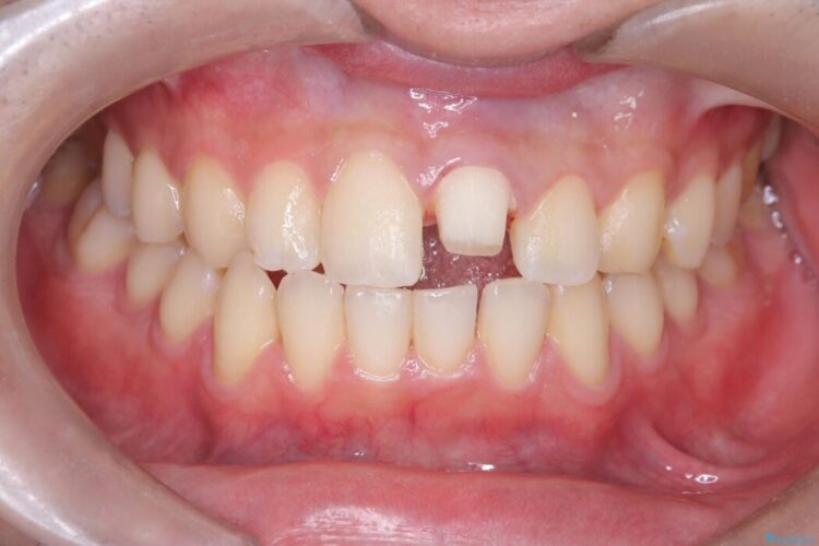 他院で治療困難と言われた|欠けた歯の神経を残しセラミック修復 治療途中画像