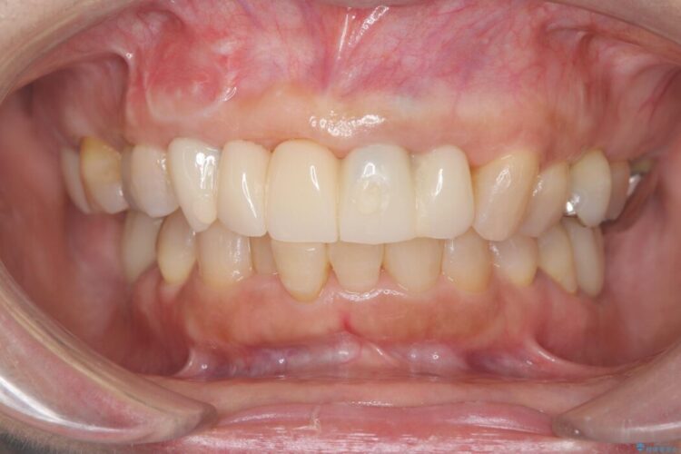 1DAYインプラント|前歯5本の治療を痛みもなく3ヶ月で完了 治療途中画像