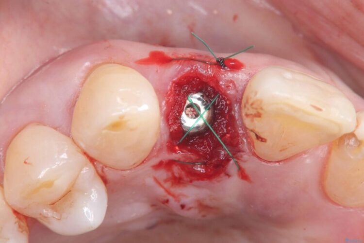 矯正治療はしたくない!抜歯即時インプラント+オールセラミッククラウンで審美修復 治療途中画像