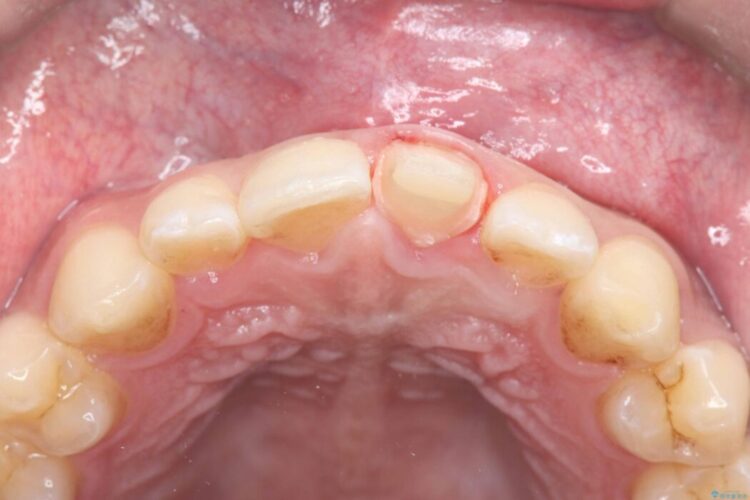 他院で治療困難と言われた|欠けた歯の神経を残しセラミック修復 治療途中画像