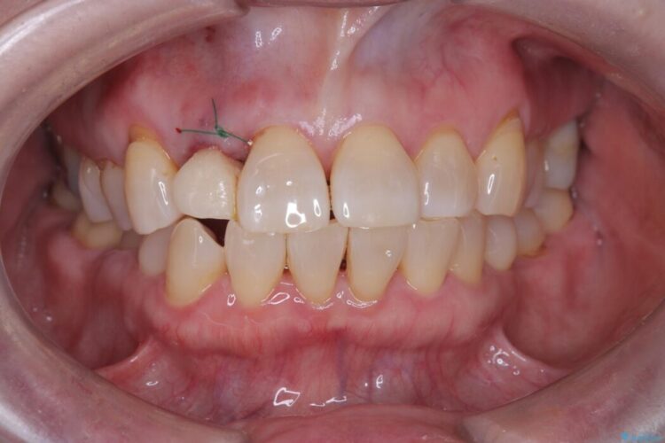 矯正治療はしたくない!抜歯即時インプラント+オールセラミッククラウンで審美修復 治療途中画像