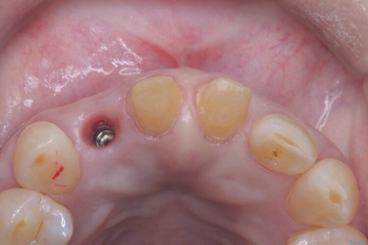 矯正治療はしたくない!抜歯即時インプラント+オールセラミッククラウンで審美修復 治療途中画像