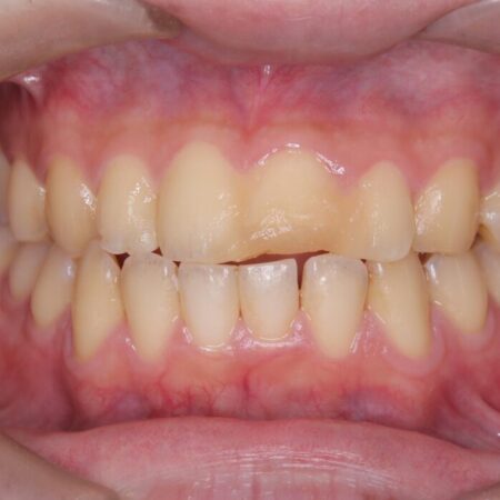 他院で治療困難と言われた|欠けた歯の神経を残しセラミック修復 治療前