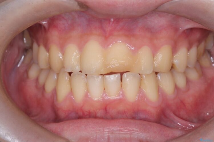 他院で治療困難と言われた|欠けた歯の神経を残しセラミック修復 ビフォー