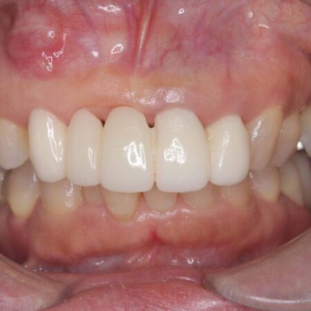 1DAYインプラント|前歯5本の治療を痛みもなく3ヶ月で完了 治療前
