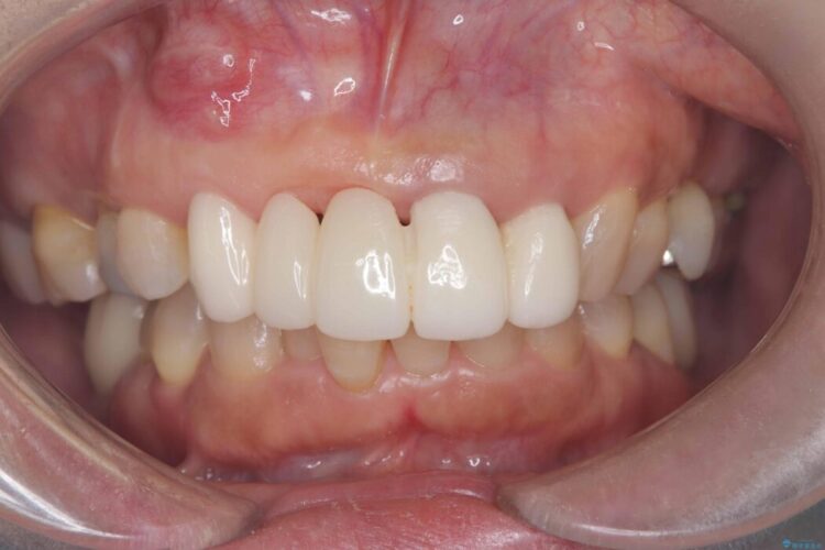 1DAYインプラント|前歯5本の治療を痛みもなく3ヶ月で完了 治療前画像