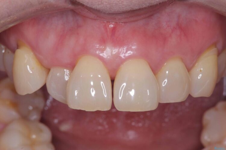 矯正治療はしたくない!抜歯即時インプラント+オールセラミッククラウンで審美修復 治療前画像