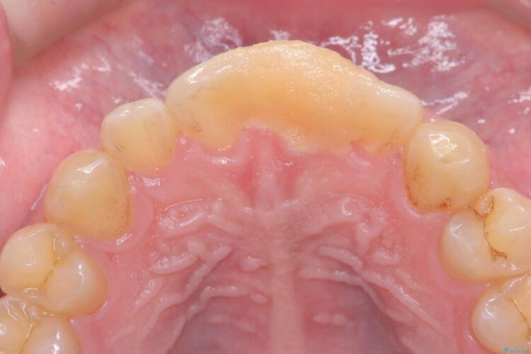 他院で治療困難と言われた|欠けた歯の神経を残しセラミック修復 治療前画像