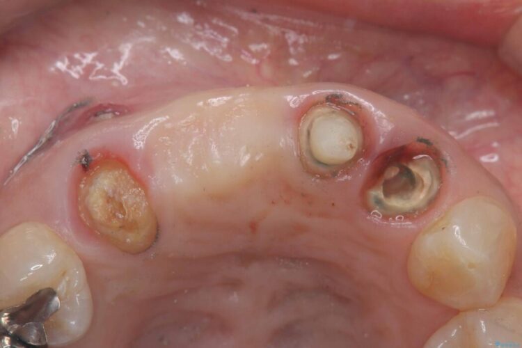 1DAYインプラント|前歯5本の治療を痛みもなく3ヶ月で完了 治療前画像