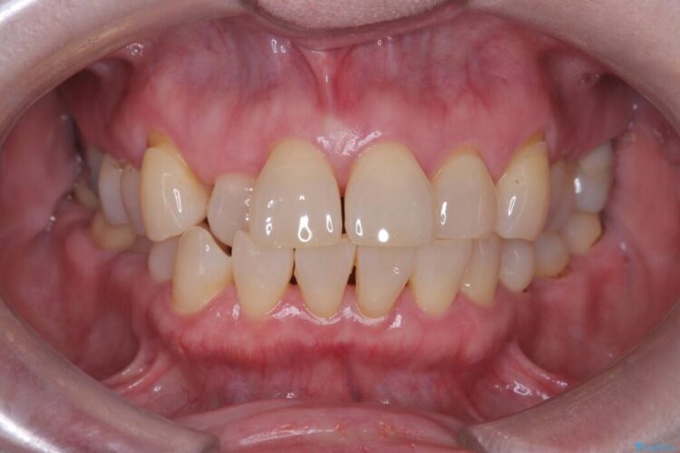 矯正治療はしたくない!抜歯即時インプラント+オールセラミッククラウンで審美修復 治療前画像