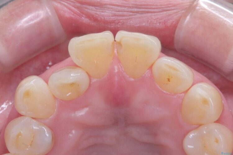 矯正治療はしたくない!抜歯即時インプラント+オールセラミッククラウンで審美修復 治療前画像