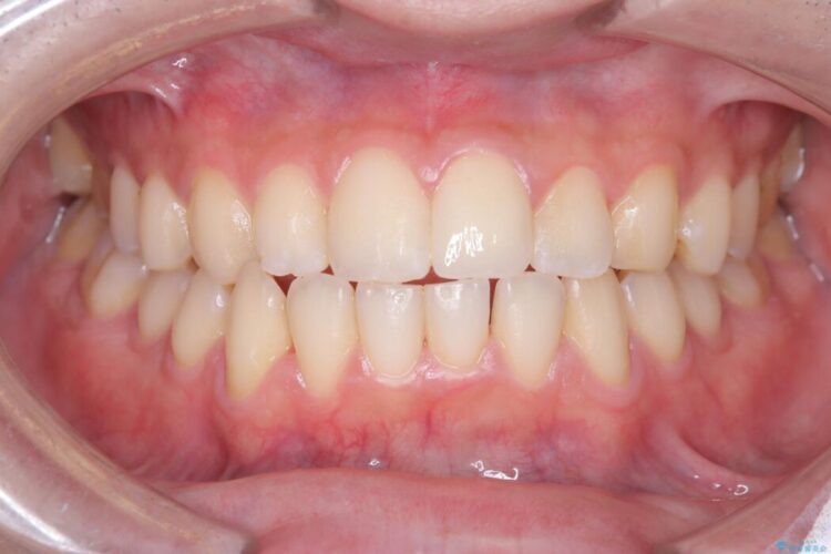 他院で治療困難と言われた|欠けた歯の神経を残しセラミック修復 アフター