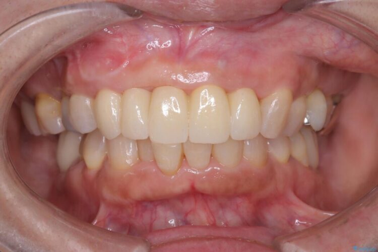 1DAYインプラント|前歯5本の治療を痛みもなく3ヶ月で完了 治療後画像