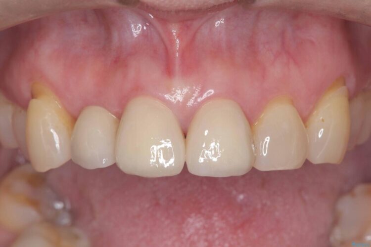 矯正治療はしたくない!抜歯即時インプラント+オールセラミッククラウンで審美修復 治療後画像